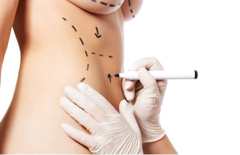 Tummy Tuck Timeline: Your Non-Surgical Options From Simon Ourian at Epione Beverly Hills