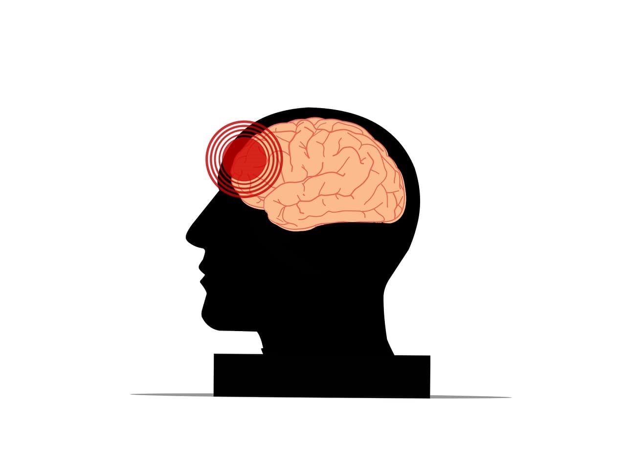 Pain and anxiety should be dealt with immediately after the diagnosis of MS