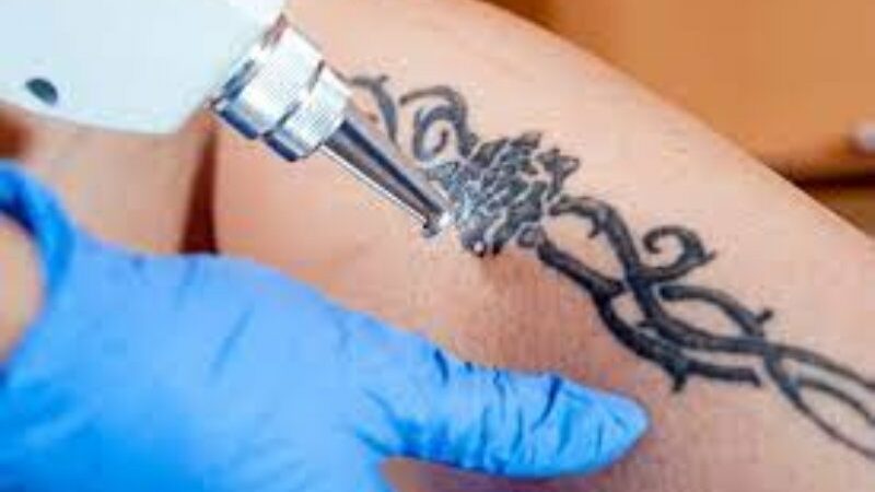 The Latest Advancements in Laser Tattoo Removal Technology in Brisbane