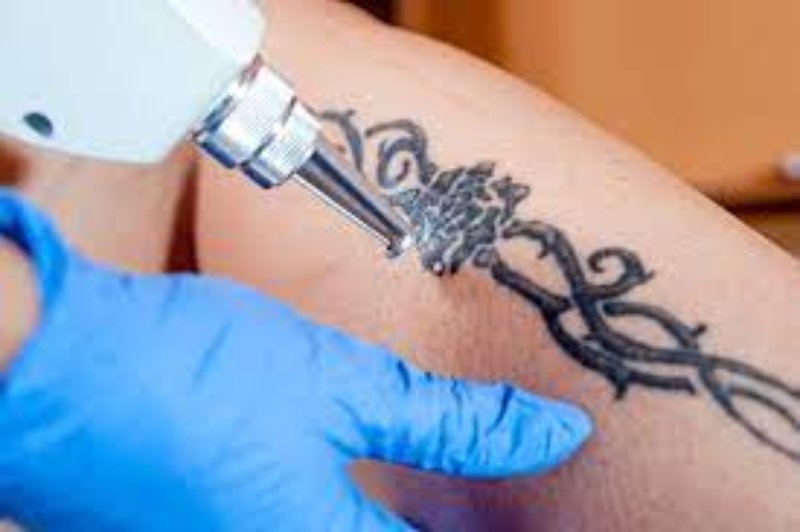 The Latest Advancements in Laser Tattoo Removal Technology in Brisbane