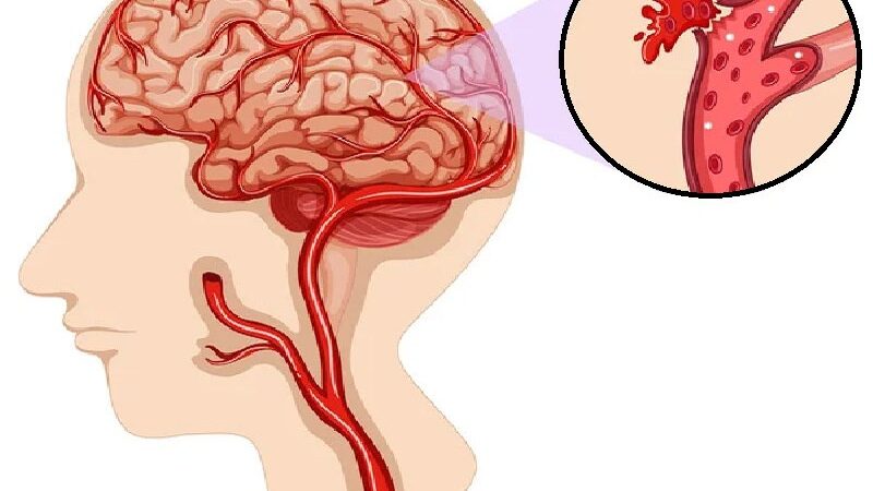 Five Unlikely Indications Of Brain Bleeding