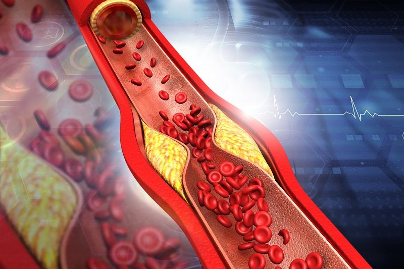 Clogged Arteries: 6 Nighttime Routines to Naturally Remove Plaque Formation