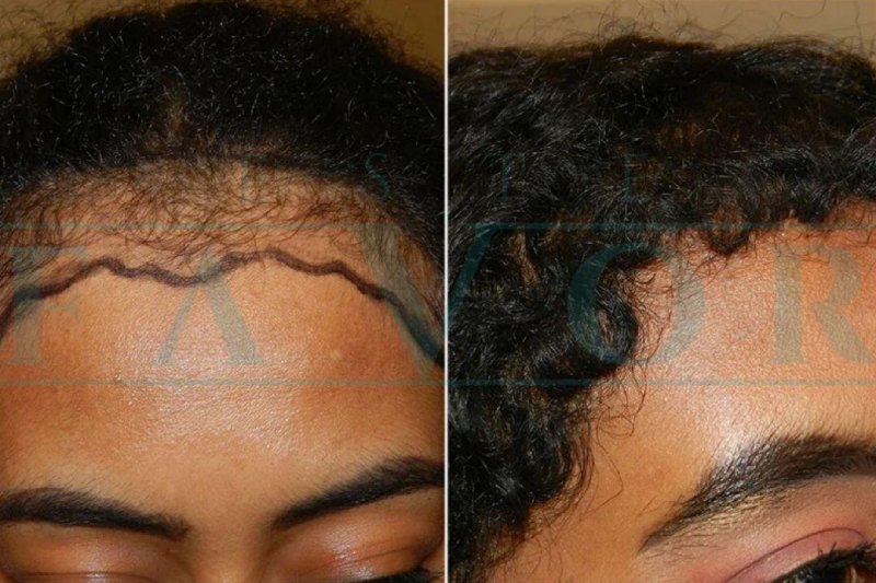 Afro Hair Transplant in Turkey: Best Clinics and Costs in 2025