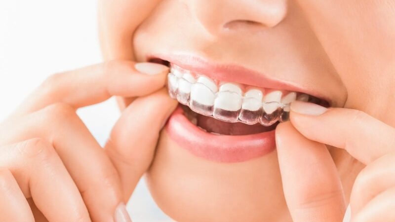 Exploring Invisalign Options In Littleton For A Straighter Smile